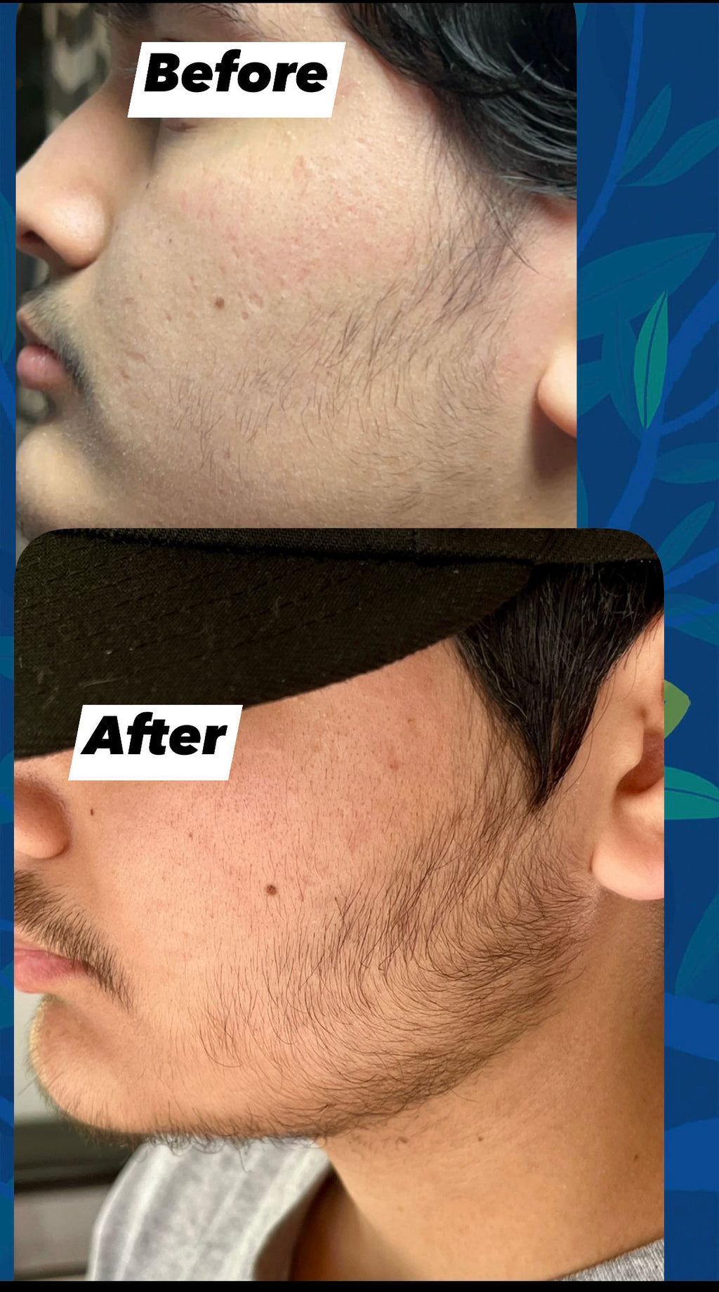 SERUM MINOXIDIL $5%