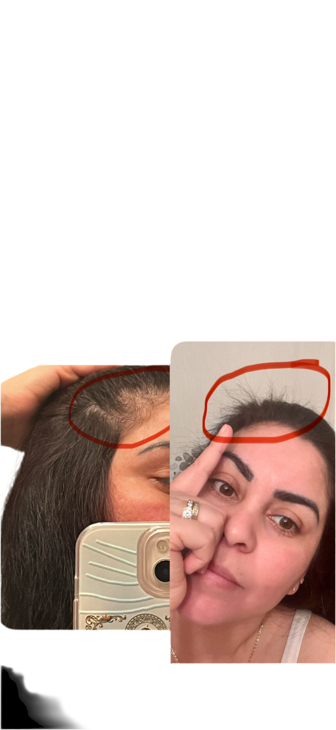 SERUM MINOXIDIL $5%
