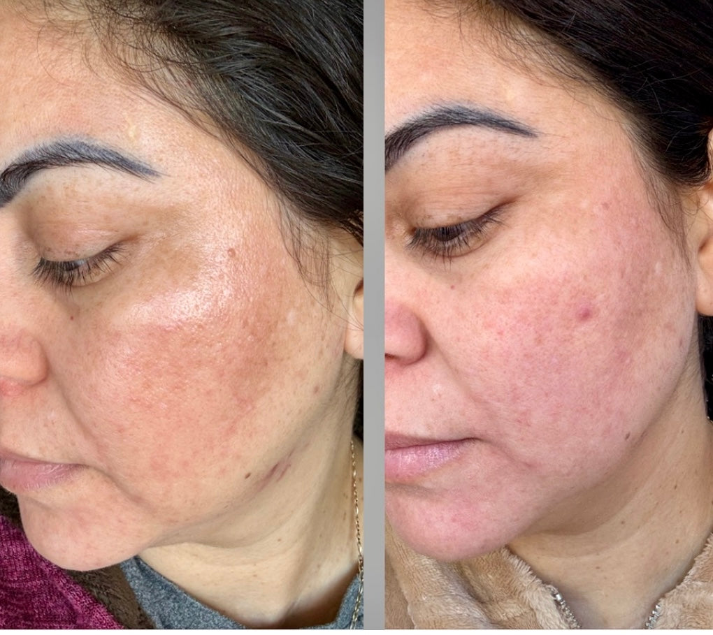 KIT FACIAL ACLARADOR INTENSO